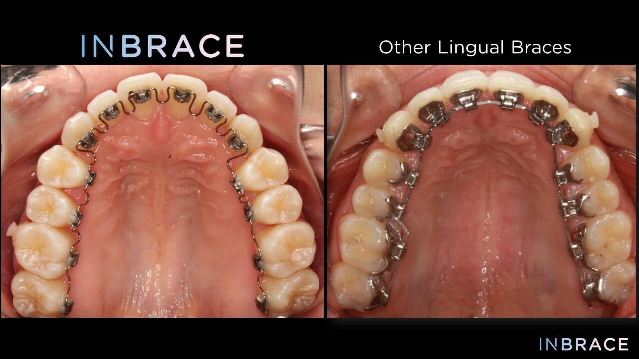 Inbrace vs. other lingual braces, INBRACE Lingual Braces (behind the teeth), Backus Smiles