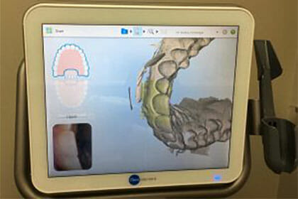 Intra-oral Scanner: iTero Element, digital image of patients teeth, Backus Smiles