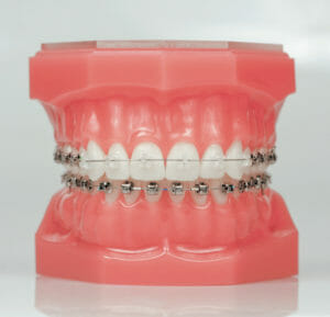 Damon Braces on the bottom and sides of the top teeth, Backus Smiles