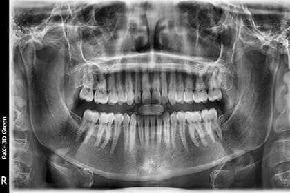 Treatments & Braces - Our Advanced Technologies - Digital X-rays & CBCT: Vatech PaX-i3DGreen, Backus Smiles, Image of Panoramic X-Ray