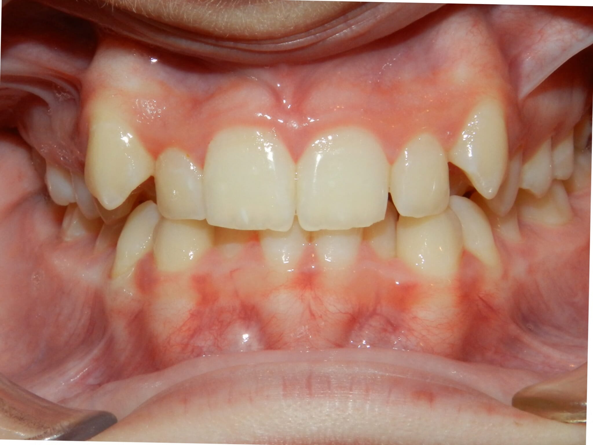 Before Orthodontic Treatment, Backus Smiles