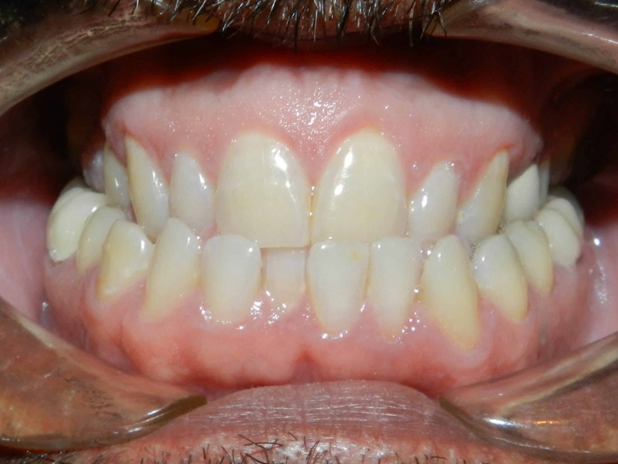 Before Orthodontic Treatment, Backus Smiles