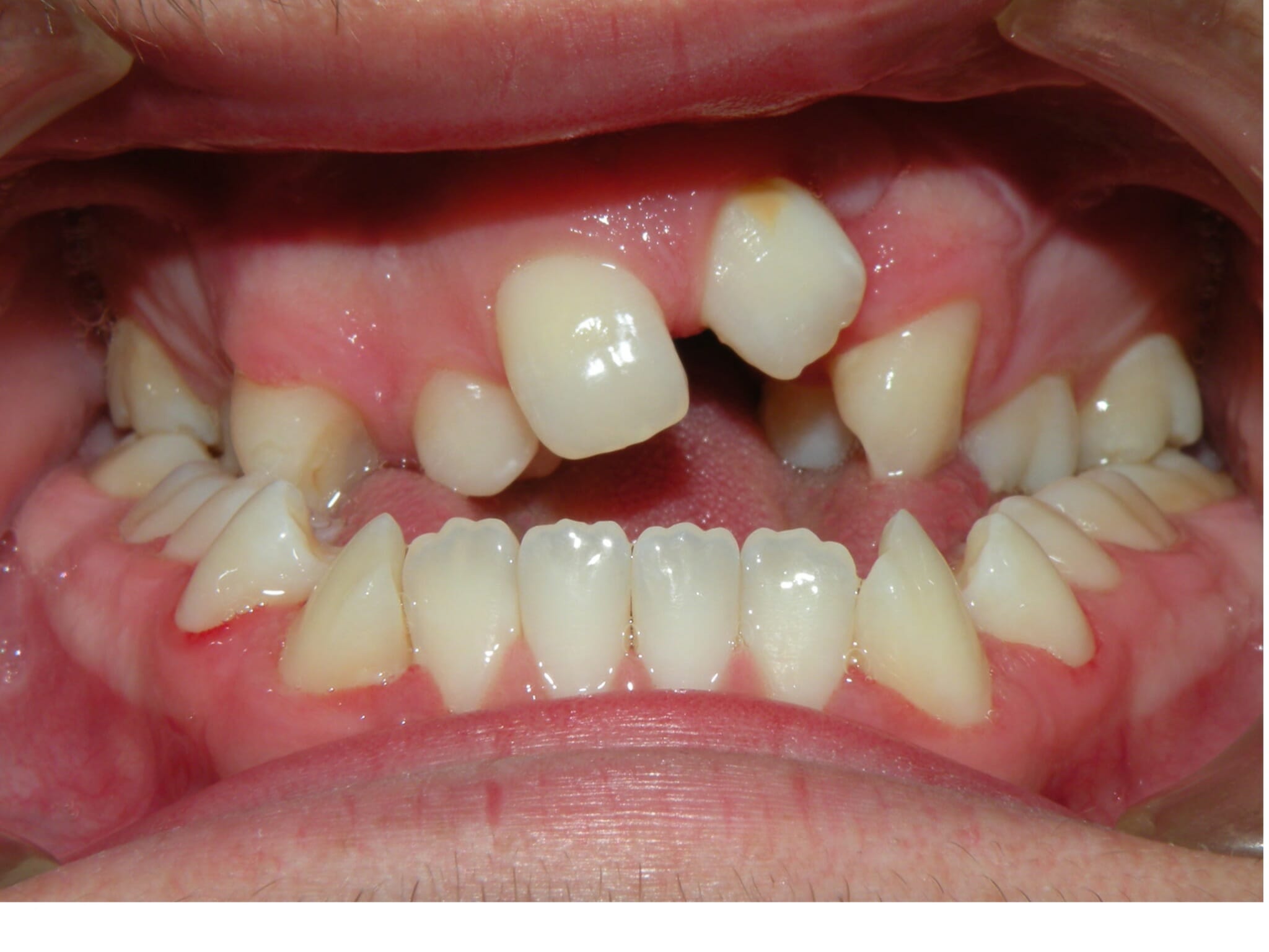 Cleft Lip and Palate, Before Orthodontic Treatment, Backus Smiles