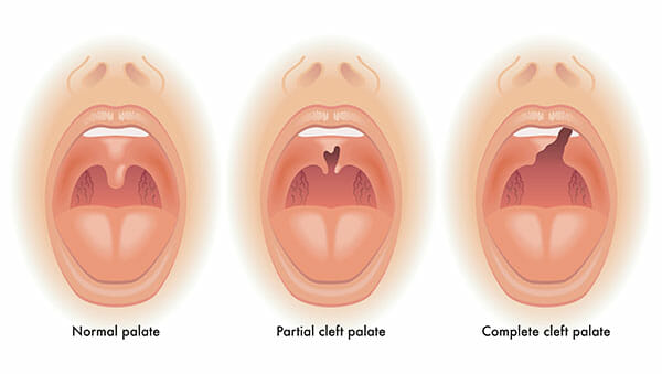 Backus Smiles, Cleft Lip and Palate and Dentofacial Deformity Treatment, Illustration of cleft palate