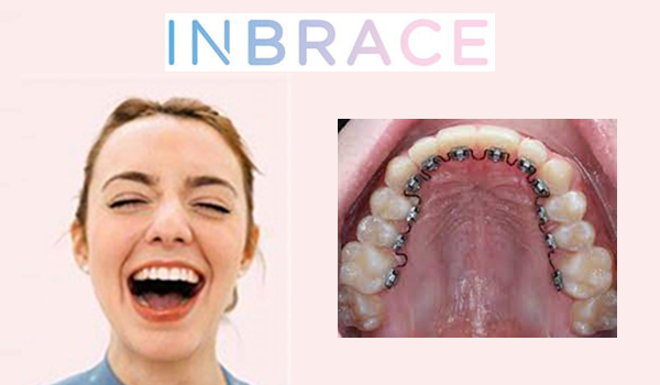 Inbrace logo, girl laughing with Inbrace and image of what her Inbraces look like, INBRACE Lingual Braces (behind the teeth), Backus Smiles